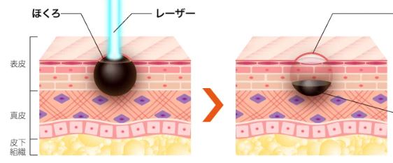 炭酸ガスレーザーでのいぼ除去