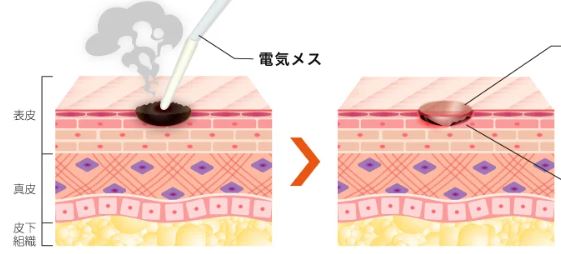 電気メスでのいぼ除去