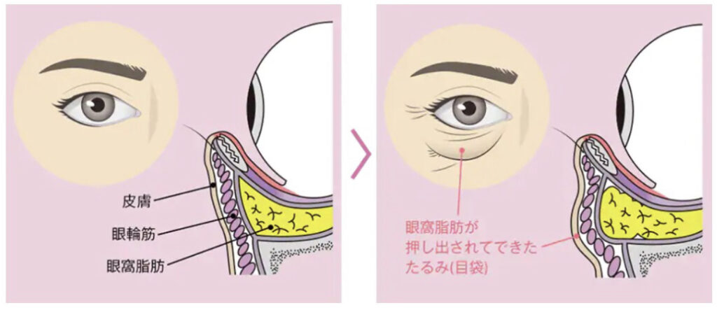眼窩(がんか)脂肪が前に押し出されて目の下がたるむ 湘南美容外科 引用画像