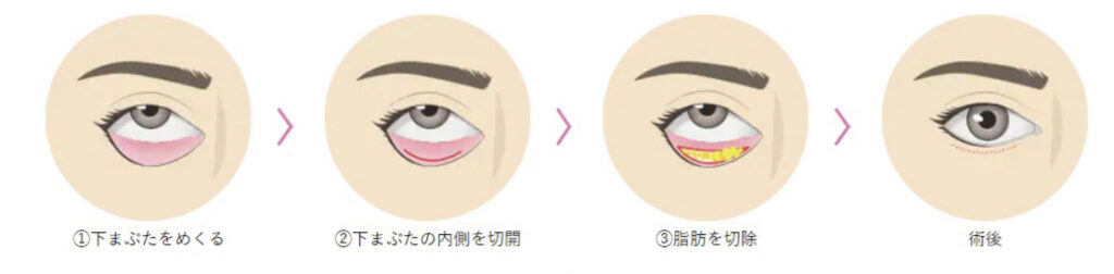 「切らない目の下のたるみ取り」の流れ 湘南美容外科 引用画像