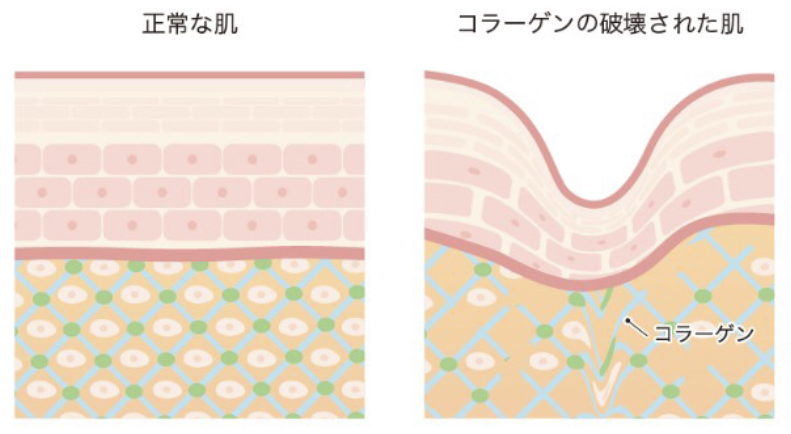 皮膚の弾力成分の減少 銀座たるみクリニック 引用画像