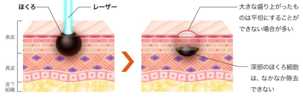 ほくろ除去は皮膚科と美容外科どっち？