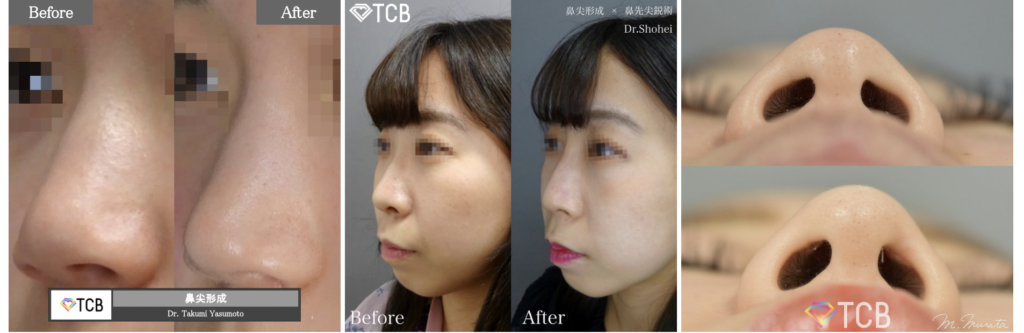 TCB 鼻尖形成　口コミ