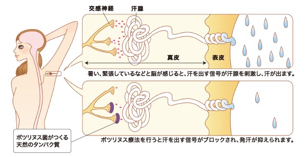 ボツリヌス療法とは