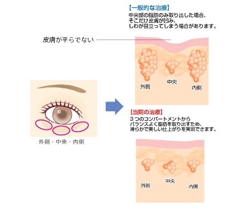 聖心美容クリニック　経結膜下脱脂法