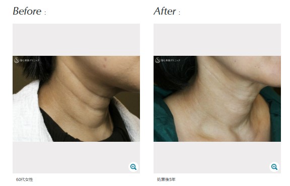 聖心美容クリニック　プレミアムPRP皮膚再生療法 症例写真