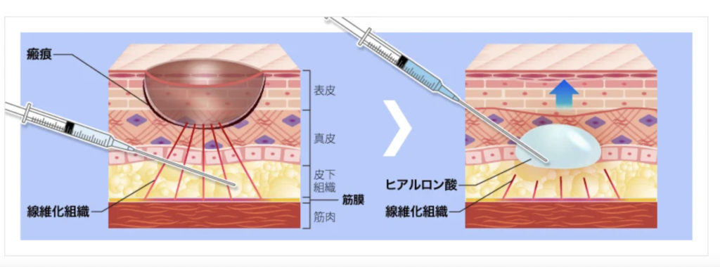 TCB東京中央美容外科　名古屋　メンズ　ニキビ跡治療