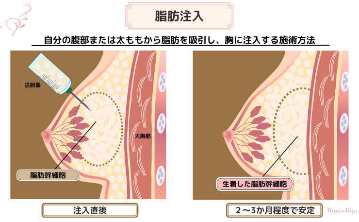 豊胸[脂肪注入図解]