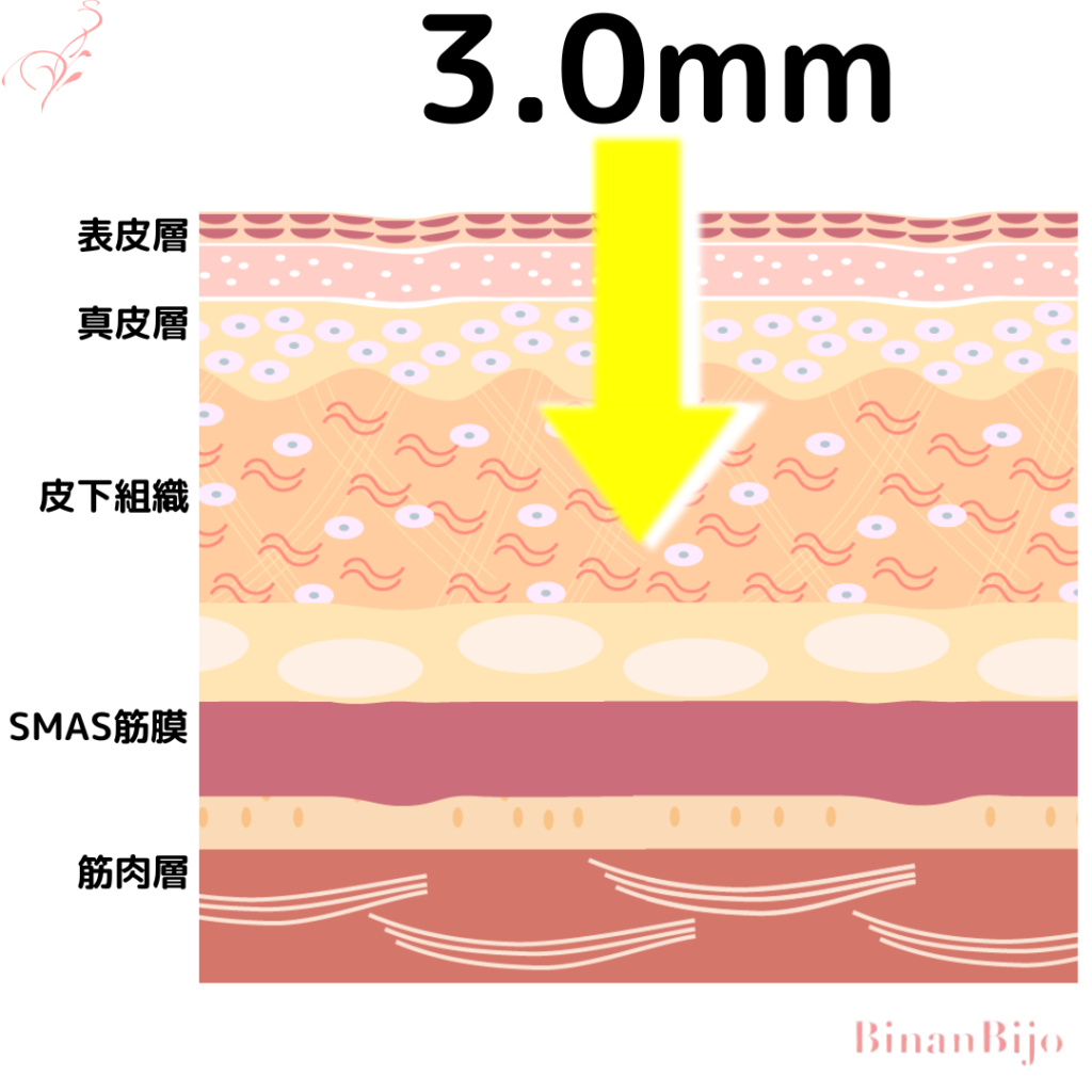 ハイフ3.0mm