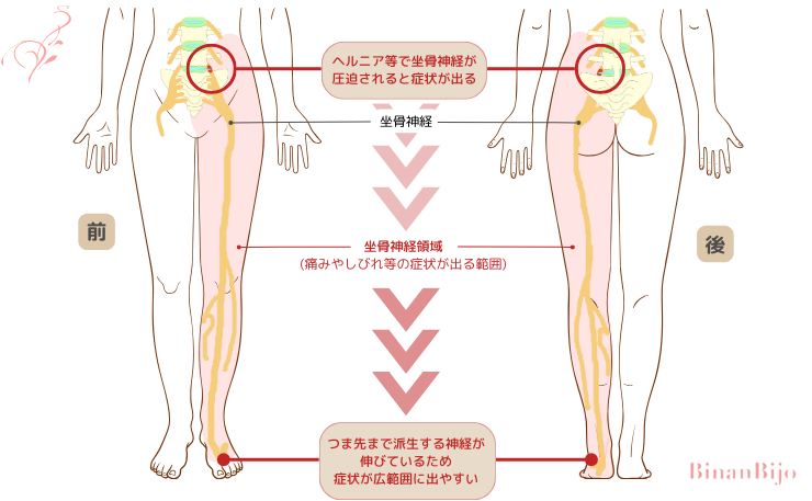 坐骨神経痛[座骨神経症状図]