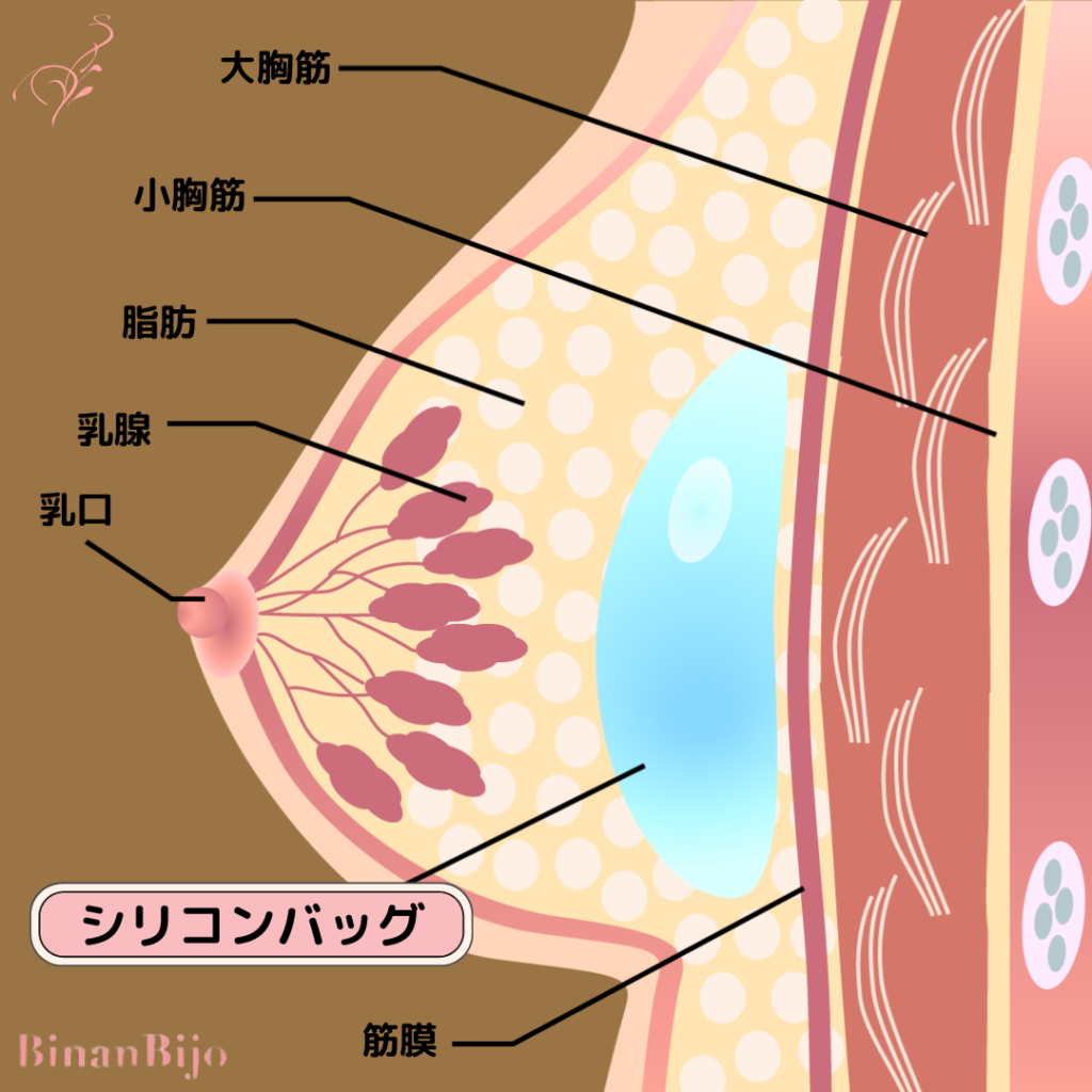 豊胸(シリコン乳腺下法)