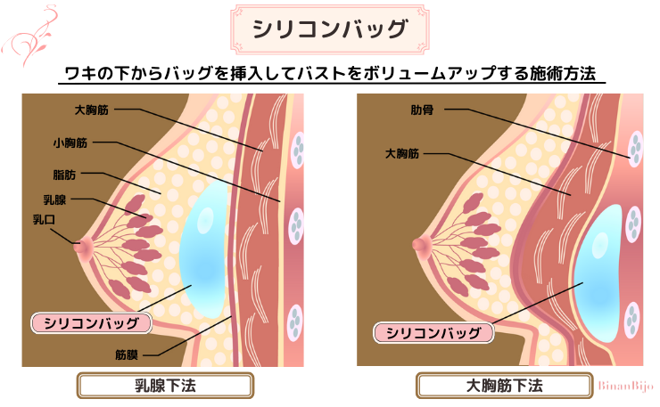 豊胸[シリコンバッグ図解]