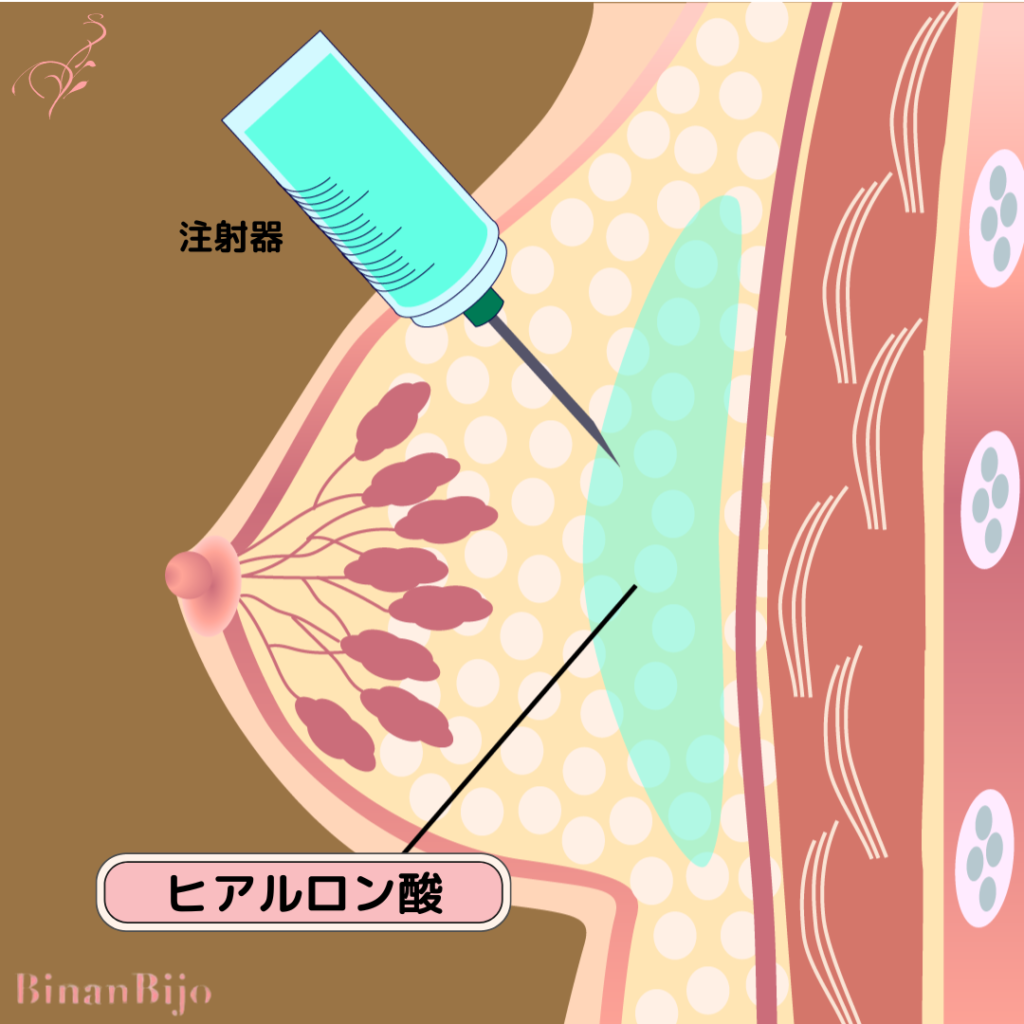 豊胸(ヒアルロン酸)