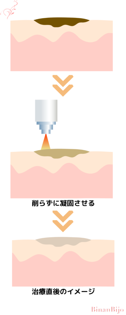 ほくろ除去（電気メス）