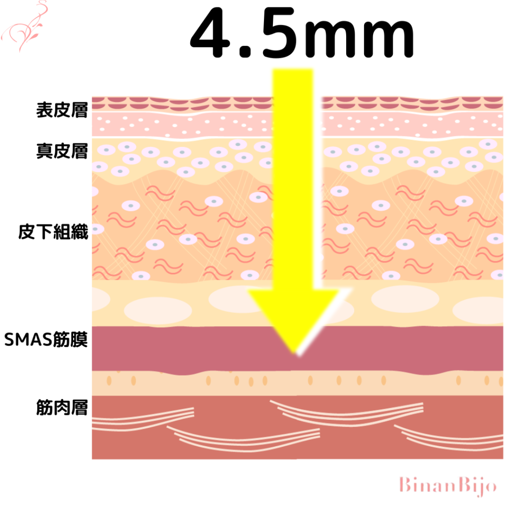 ハイフ4.5mm