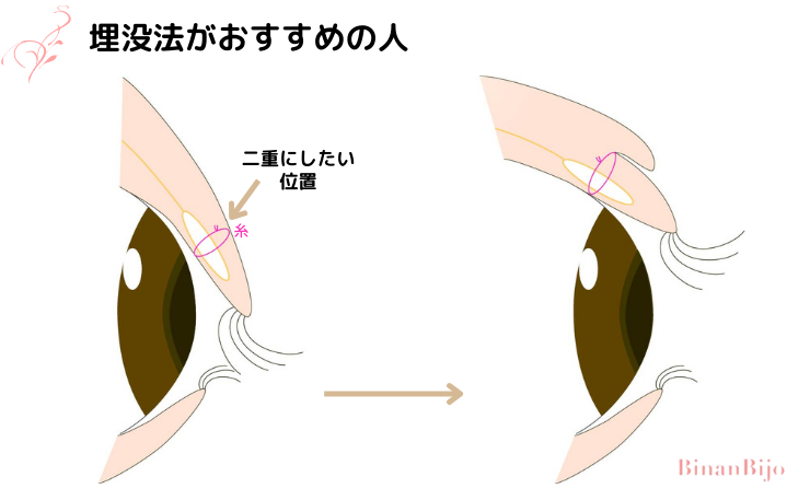 埋没法がおすすめの人