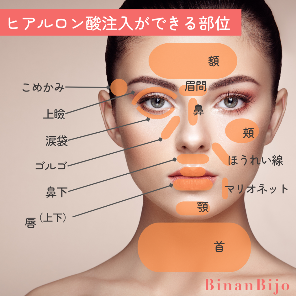 ヒアルロン酸注入部位