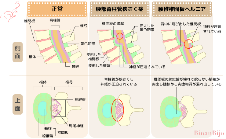 坐骨神経痛[脊柱管狭窄症と腰椎椎間板ヘルニア]