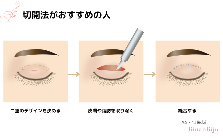 切開法がおすすめの人