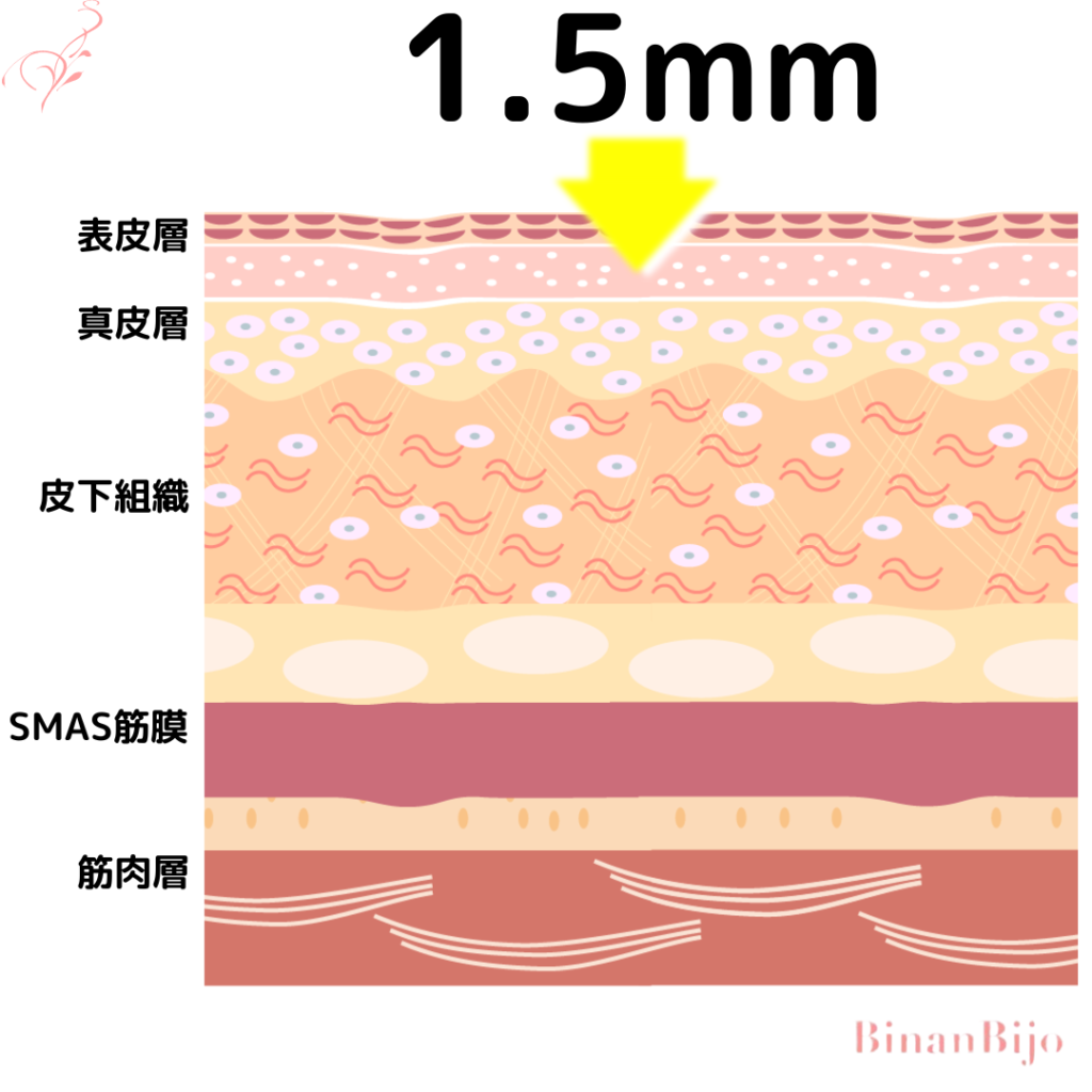 ハイフ1.5mm