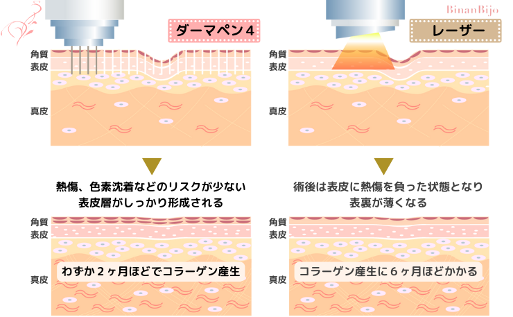 ダーマペンレーザー比較