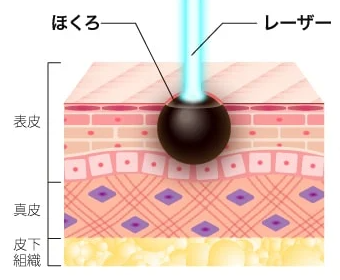 ほくろ除去レーザー
