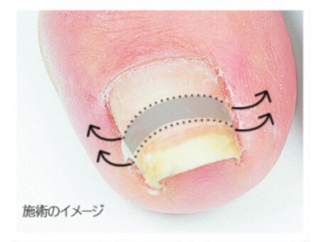 【巻き爪ケア】ドイツ製巻爪矯正