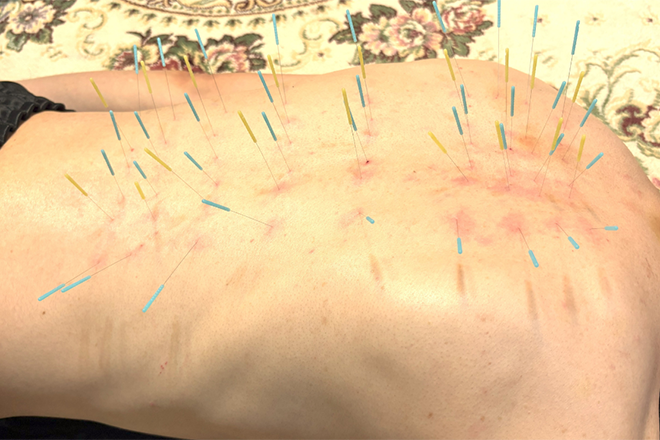 首こり肩こり腰痛自律神経 トリガーポイント広島とだ鍼灸院 | 八丁堀/白島/牛田のリラクゼーション 首こり肩こり腰痛自律神経 トリガーポイント広島とだ鍼灸院 | 八丁堀/白島/牛田のリラクゼーション