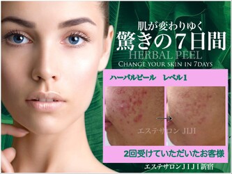 ハーバルピール・フェイシャル専門 エステサロンJIJI新宿 | 新宿のエステサロン ハーバルピール・フェイシャル専門 エステサロンJIJI新宿 | 新宿のエステサロン