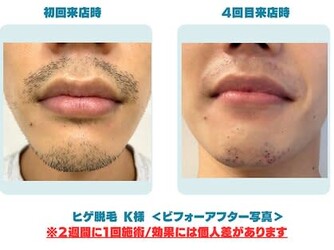 メンズ脱毛NEXT+梅田店 | 梅田のエステサロン メンズ脱毛NEXT+梅田店 | 梅田のエステサロン