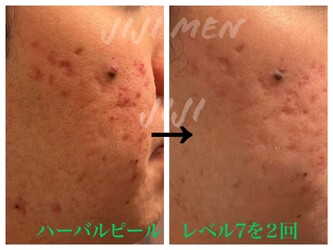 ハーバルピール・フェイシャル/ヘッド専門 エステティックサロンJ IJ I M E N | 新宿のエステサロン ハーバルピール・フェイシャル/ヘッド専門 エステティックサロンJ IJ I M E N | 新宿のエステサロン