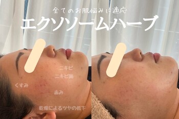 小顔・肌質改善サロンespoir ハーブピーリング/毛穴 | 心斎橋のエステサロン 小顔・肌質改善サロンespoir ハーブピーリング/毛穴 | 心斎橋のエステサロン