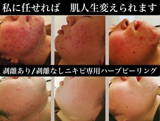 肌質改善専門店×ハーブピーリング Snow skin | 千葉のエステサロン 肌質改善専門店×ハーブピーリング Snow skin | 千葉のエステサロン