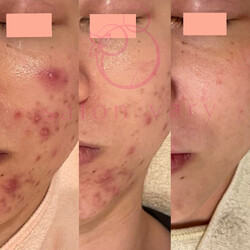 肌質改善水玉リフティング&ハーブピーリングsalonvary | 恵比寿のエステサロン 肌質改善水玉リフティング&ハーブピーリングsalonvary | 恵比寿のエステサロン