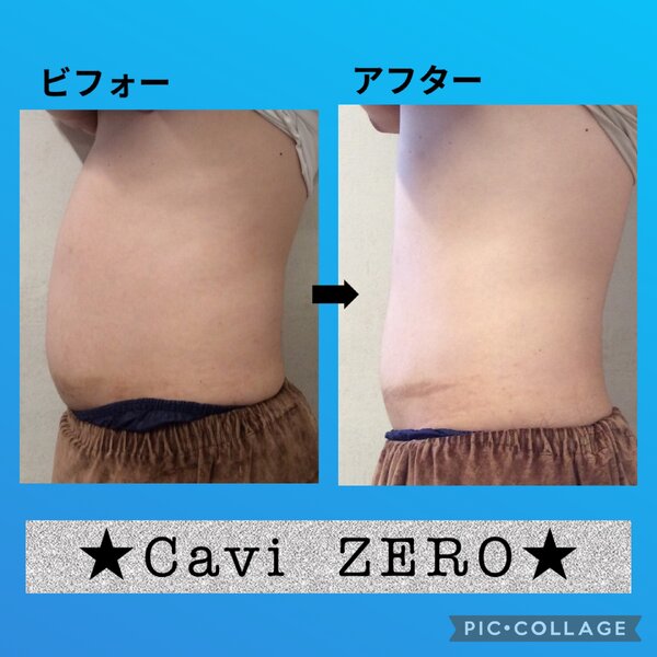 [アイキャッチ]ポッテリお腹激変！！自分で落としきれない脂肪はCavi ZERO(キャビゼロ) にお任せ✨